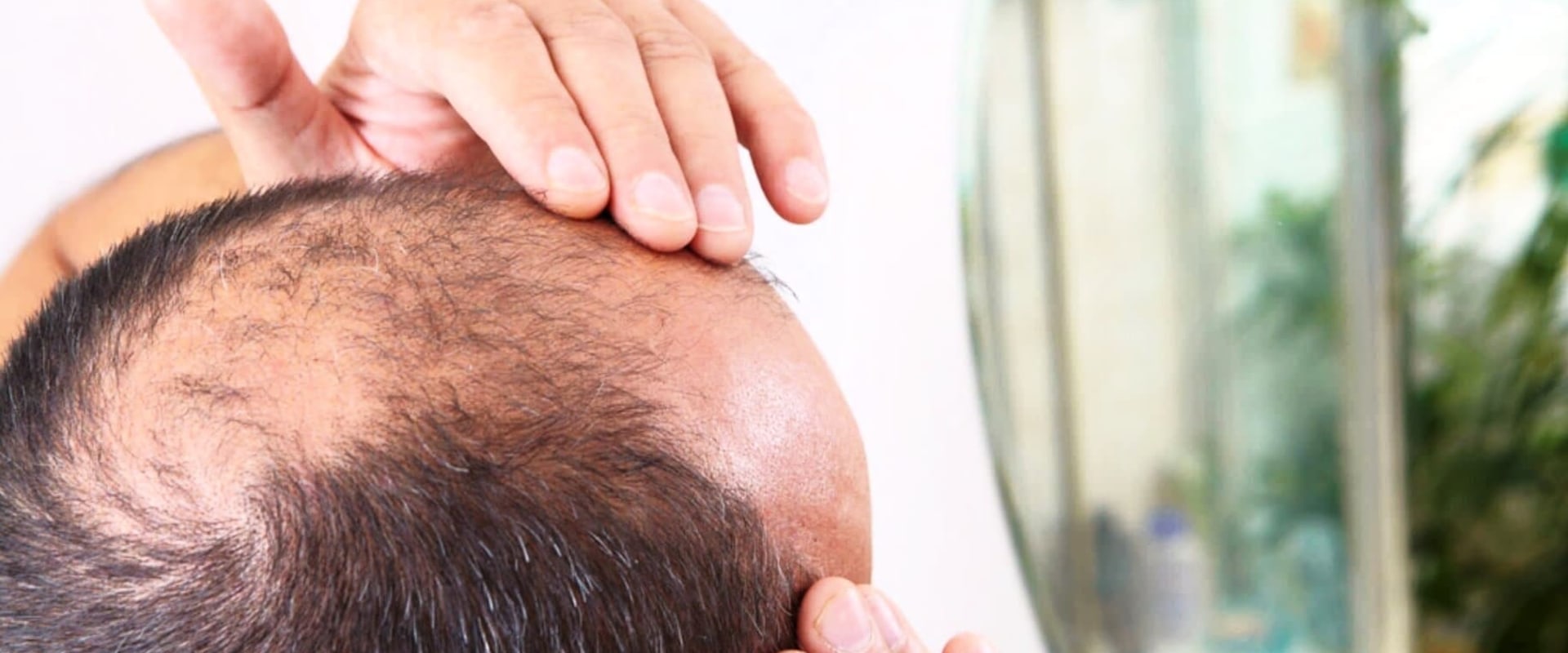 Understanding Male Pattern Baldness: Causes and Genetics