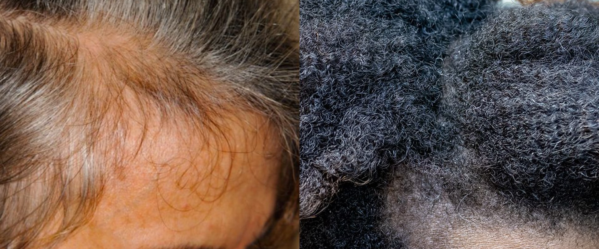 Understanding the Relationship between Stress and Hair Loss