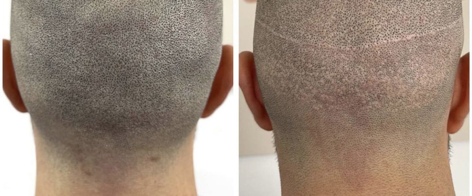 Scalp Camouflage Techniques: Hiding Hair Loss with Confidence