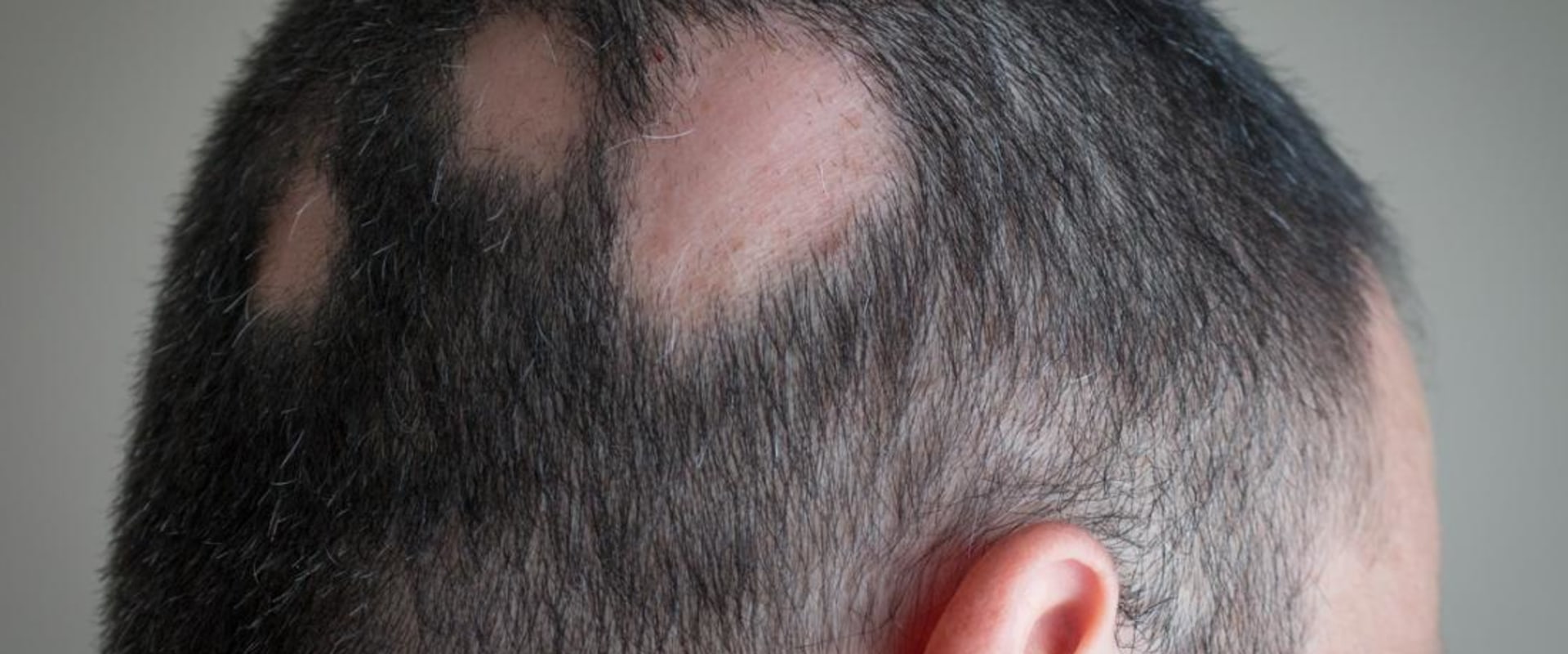 Understanding Alopecia: The Causes and Medical Conditions Behind Hair Loss