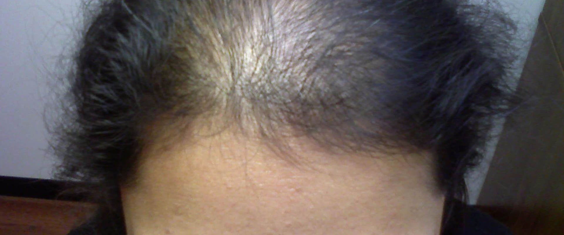 Understanding Iron-deficiency Anemia and Hair Loss