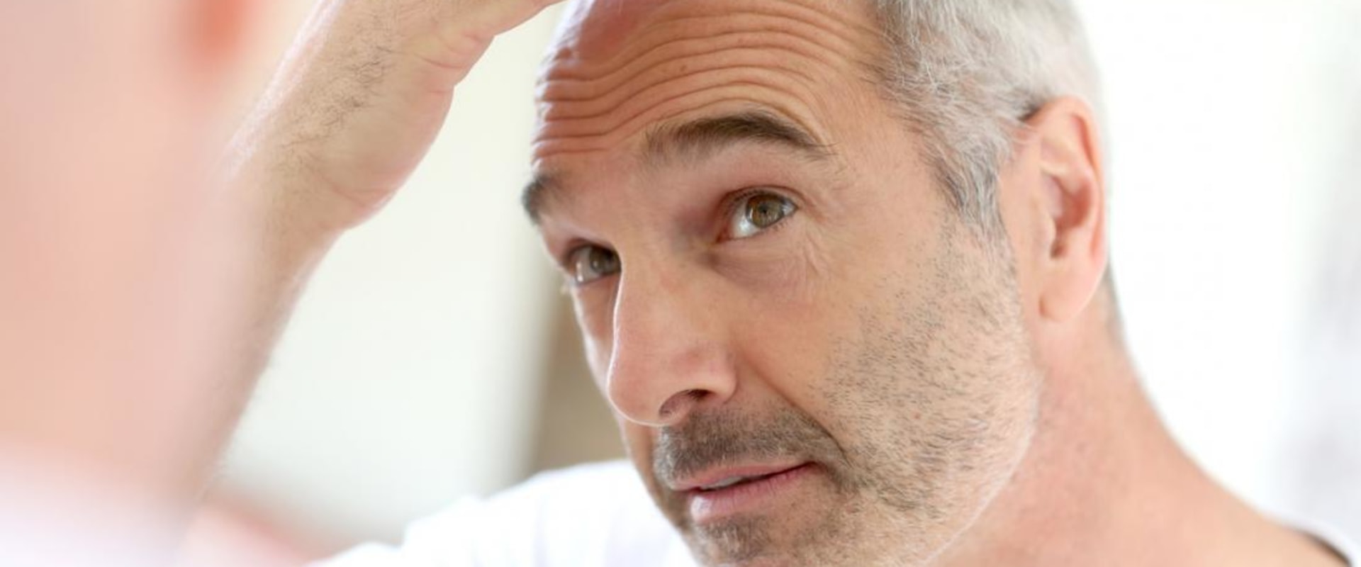 Understanding Male Pattern Baldness: Causes, Symptoms, and Treatment