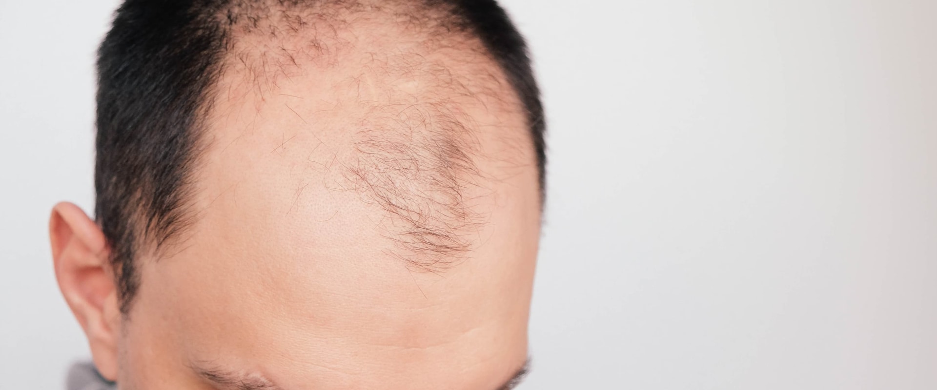 An In-Depth Look at Finasteride for Hair Loss Treatment