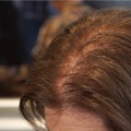 Lifestyle Changes to Prevent Female Hair Loss