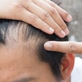 Lifestyle Changes for Preventing Male Pattern Baldness: A Comprehensive Guide