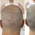 Scalp Camouflage Techniques: Hiding Hair Loss with Confidence