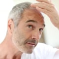 Understanding Male Pattern Baldness: Causes, Symptoms, and Treatment