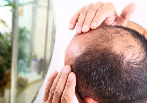 Understanding Male Pattern Baldness: Causes and Genetics