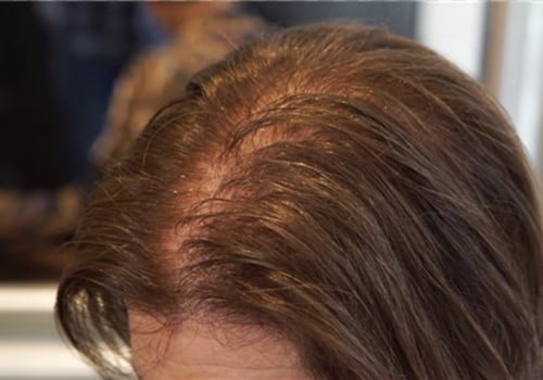 Lifestyle Changes to Prevent Female Hair Loss