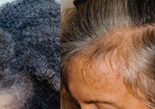 Understanding the Relationship between Stress and Hair Loss