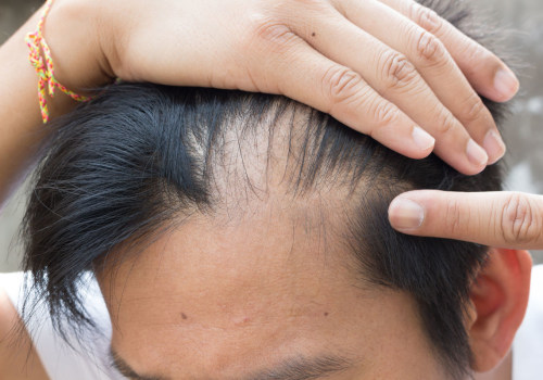 Lifestyle Changes for Preventing Male Pattern Baldness: A Comprehensive Guide