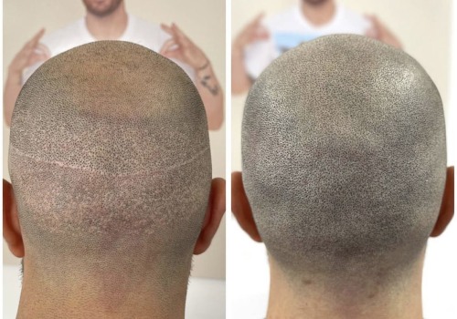 Scalp Camouflage Techniques: Hiding Hair Loss with Confidence