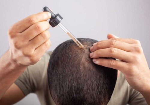 Understanding the Benefits and Uses of Minoxidil